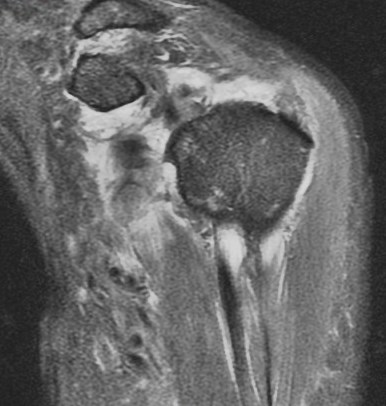 Figure 3 for case HAGL lesion and rotator cuff tears